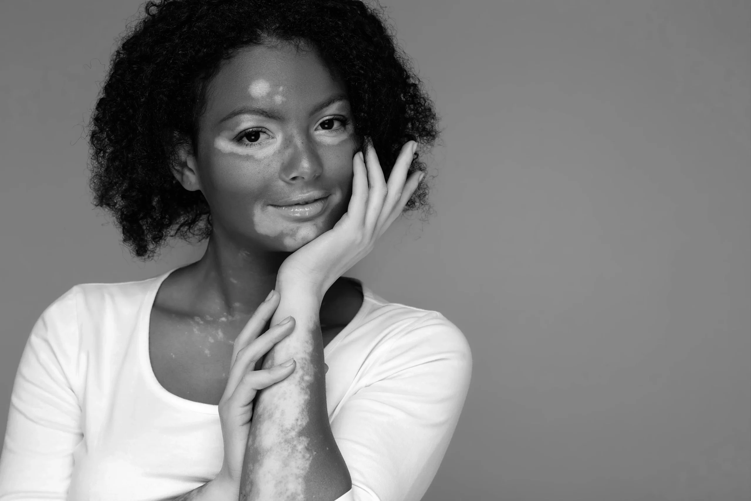 A black and white portrait of a young woman with vitiligo on her face, neck, and arms. She has curly hair and is smiling softly while resting her chin on her hand, her other hand clasped over it. She is wearing a light-colored top.